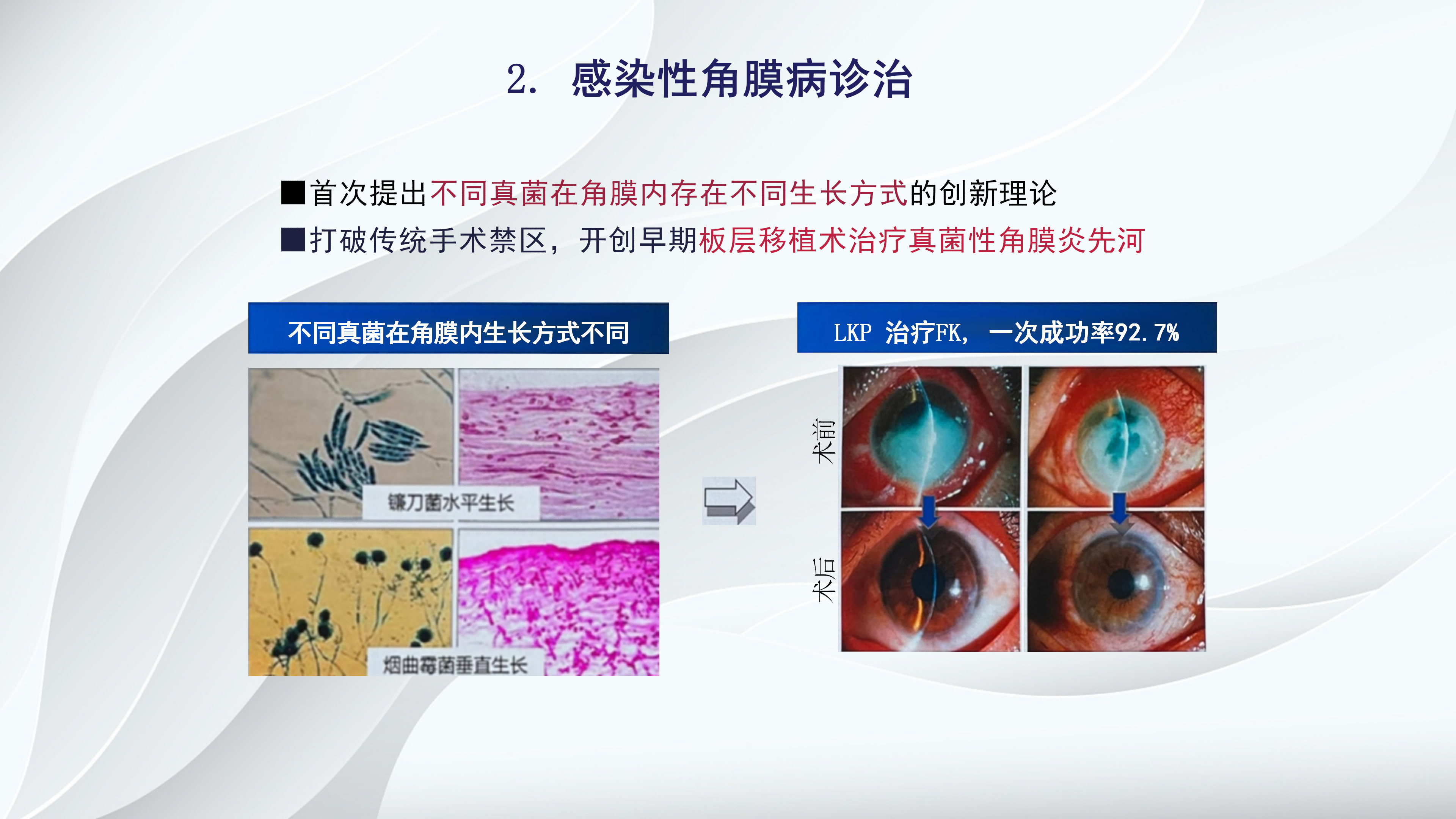 角膜病新进展-沧州市眼科医院-杨立东